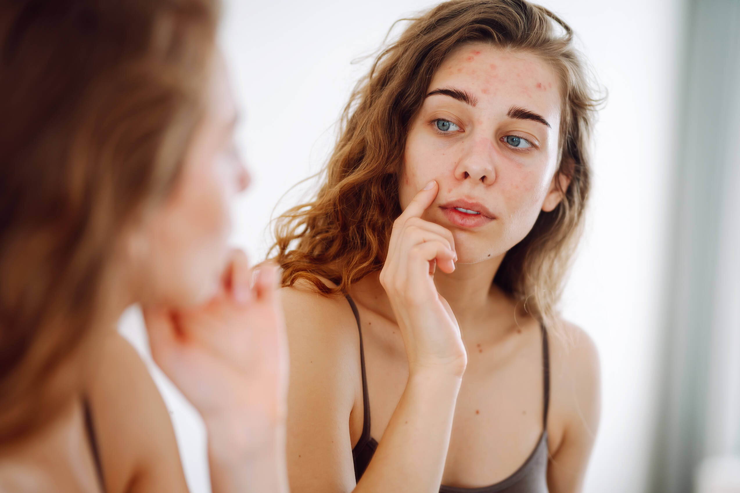 Closeup cute woman with problem skin looking mirror dermatology concept allergy