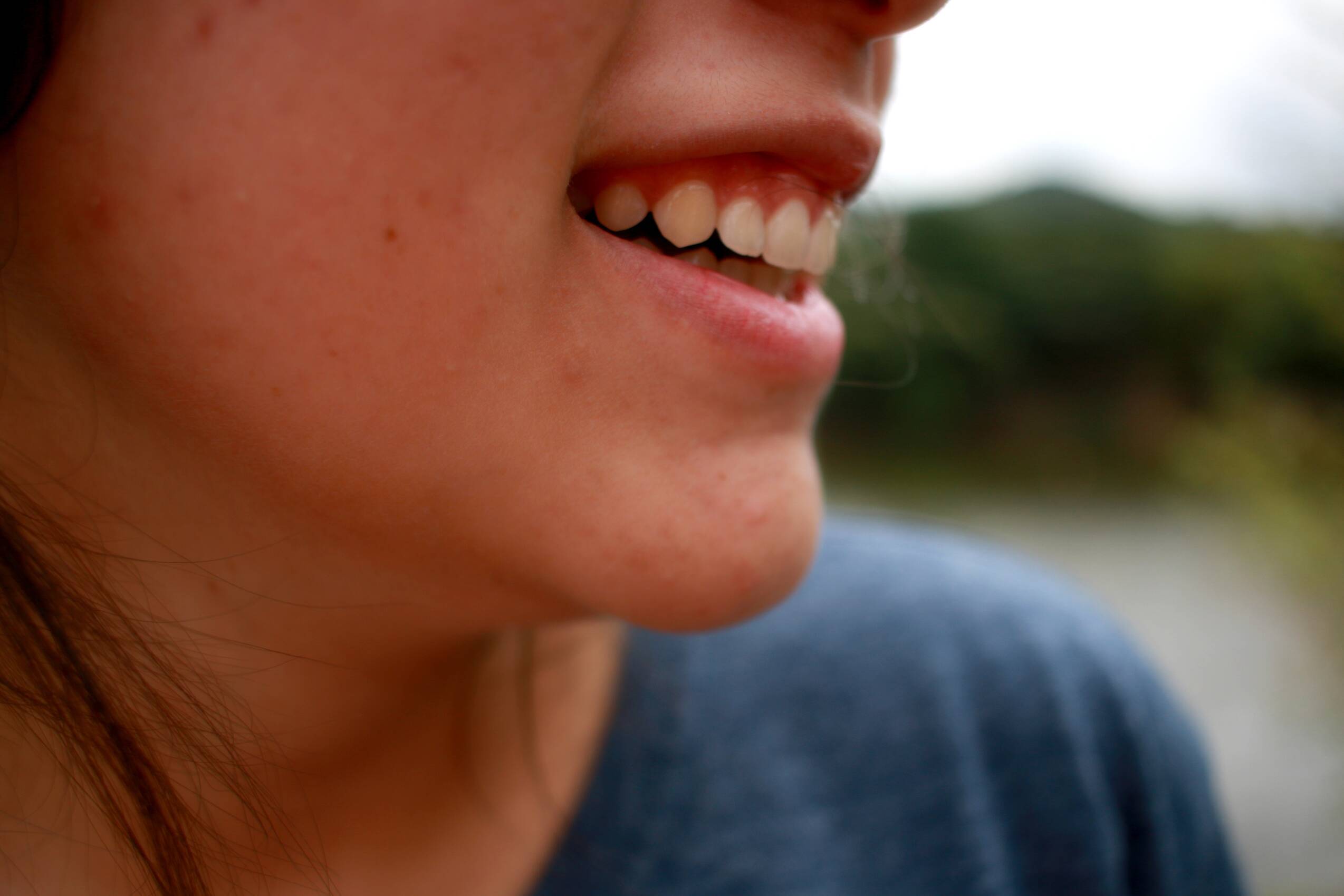smile, woman, love, person, acne, shin, caucasian, people, young, dermatology, puberty, portrait, epidermis, irritation, cosmetic, expensive, facial, beauty, acne, acne, acne, acne, acne