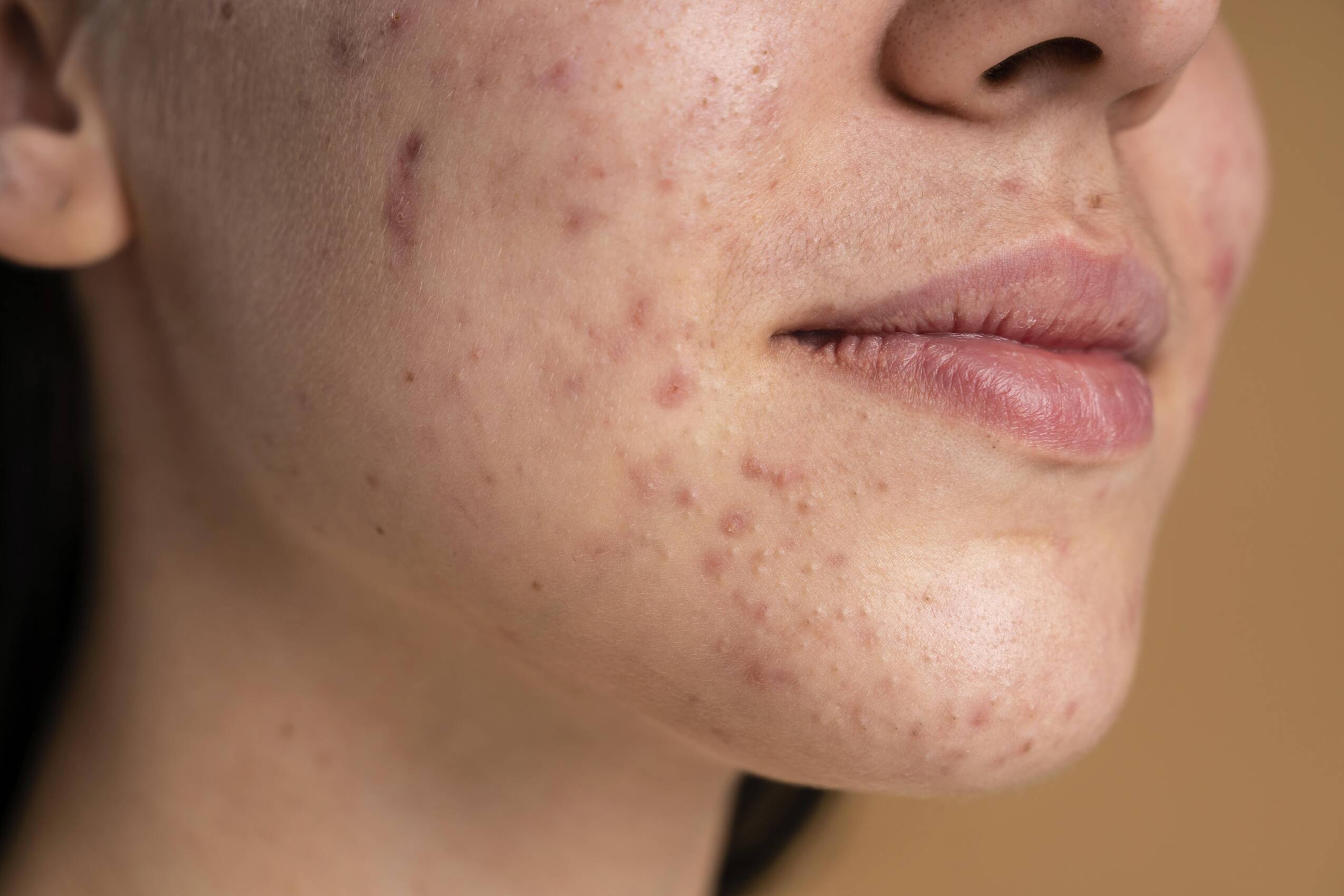 Confident young woman with acne close up