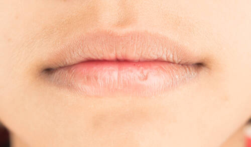 Dry lips peeling
